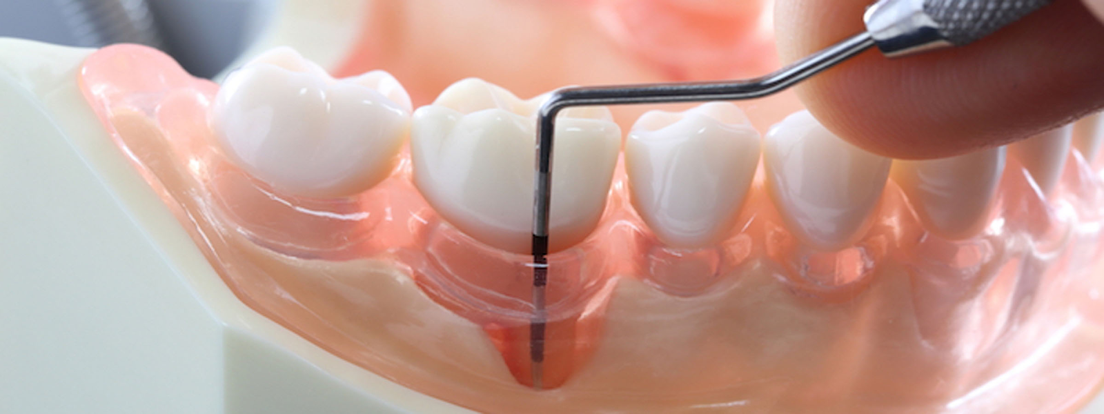 Как лечить пародонтит зуба?