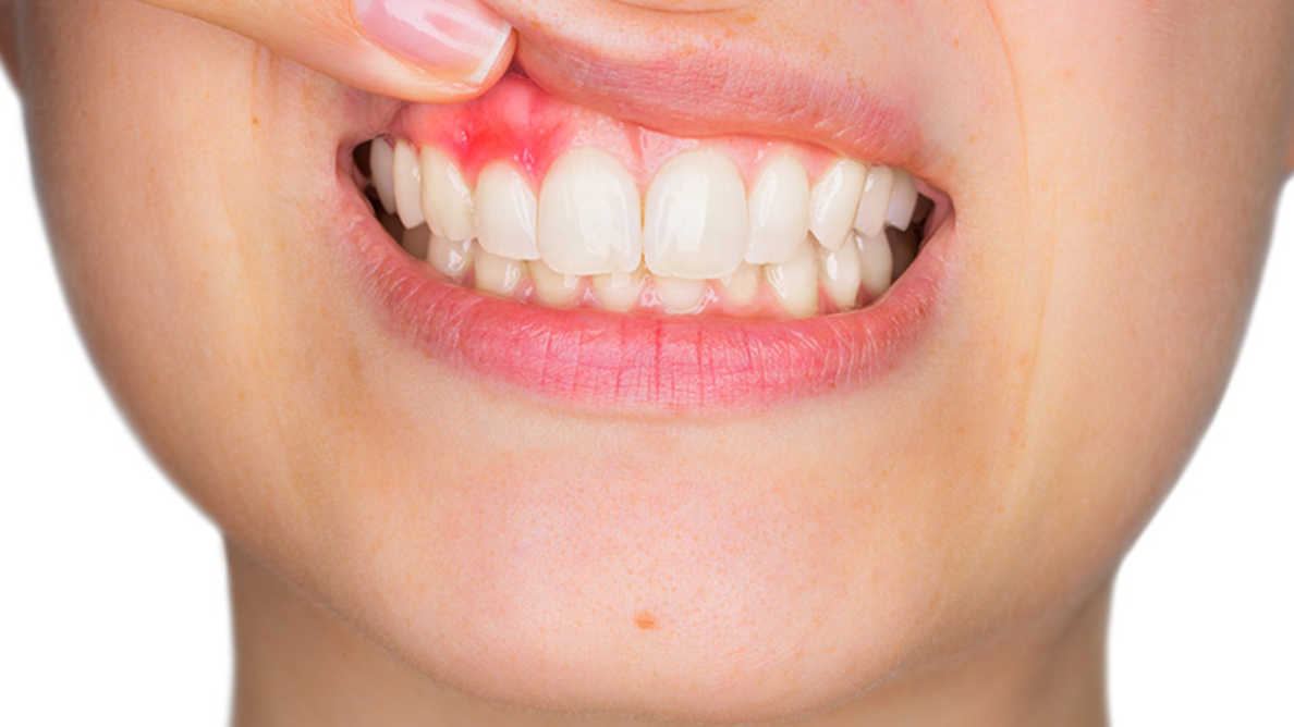 Симптомы и лечение периодонтита зуба