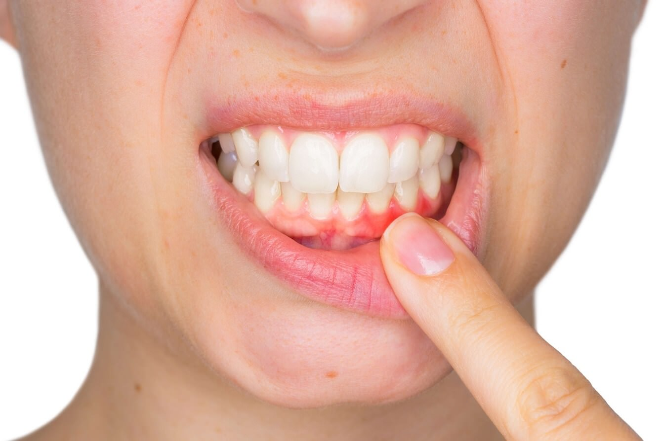 Обострение хронического периодонтита зуба: методы лечения