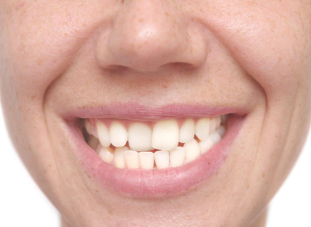 Кривые зубы у взрослых