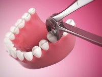 Сколько стоит удалить зуб?